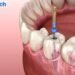 Root Canal Specialist in Jalandhar – What to Expect