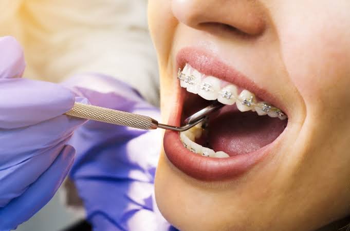 metal braces orthodontic treatment Phagwara Jalandhar