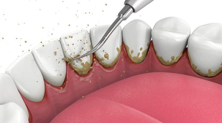 scaling root planing gum treatment Phagwara Jalandhar