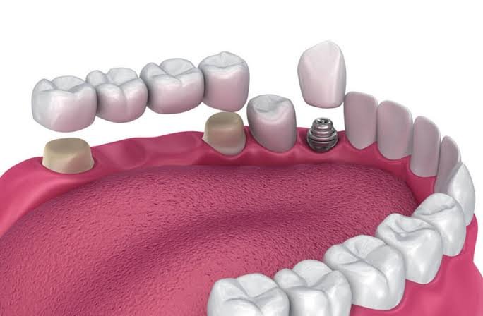 dental implant for missing teeth replacement Phagwara Jalandhar