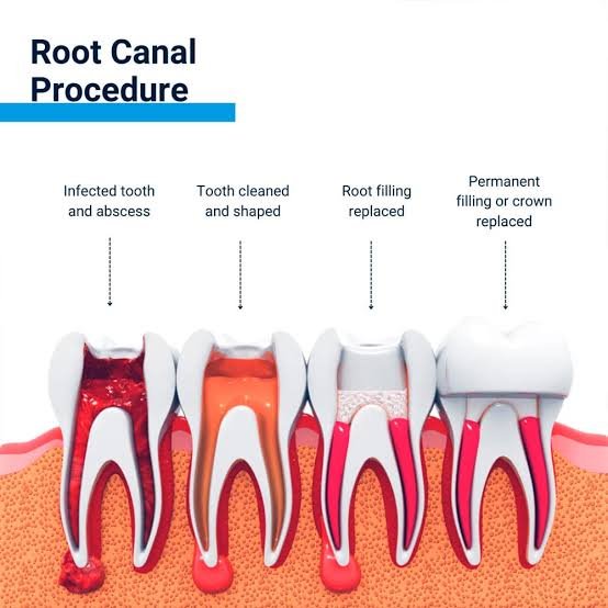 root canal diagnosis X-ray Phagwara Jalandhar